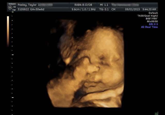 3D ultrasound 31 weeks
