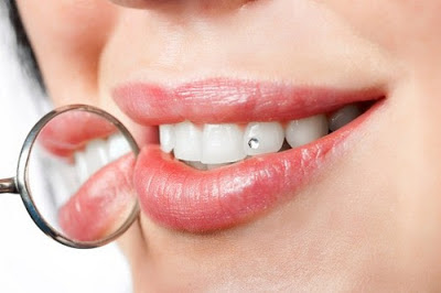 Đính đá răng có hại không? 