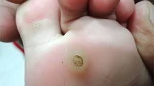 plantar warts