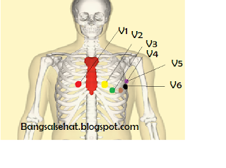  Cara  memasang lead EKG  dengan baik dan benar sesuai dengan 