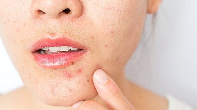 Under the surface: Understanding and treating under the skin acne