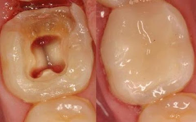 Sâu răng có nên trám răng không?