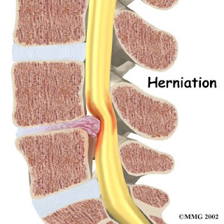 lumbar herniation causing stenosis