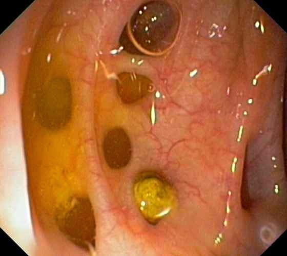 obat kanker usus tradisional stadium 2, obat kanker usus