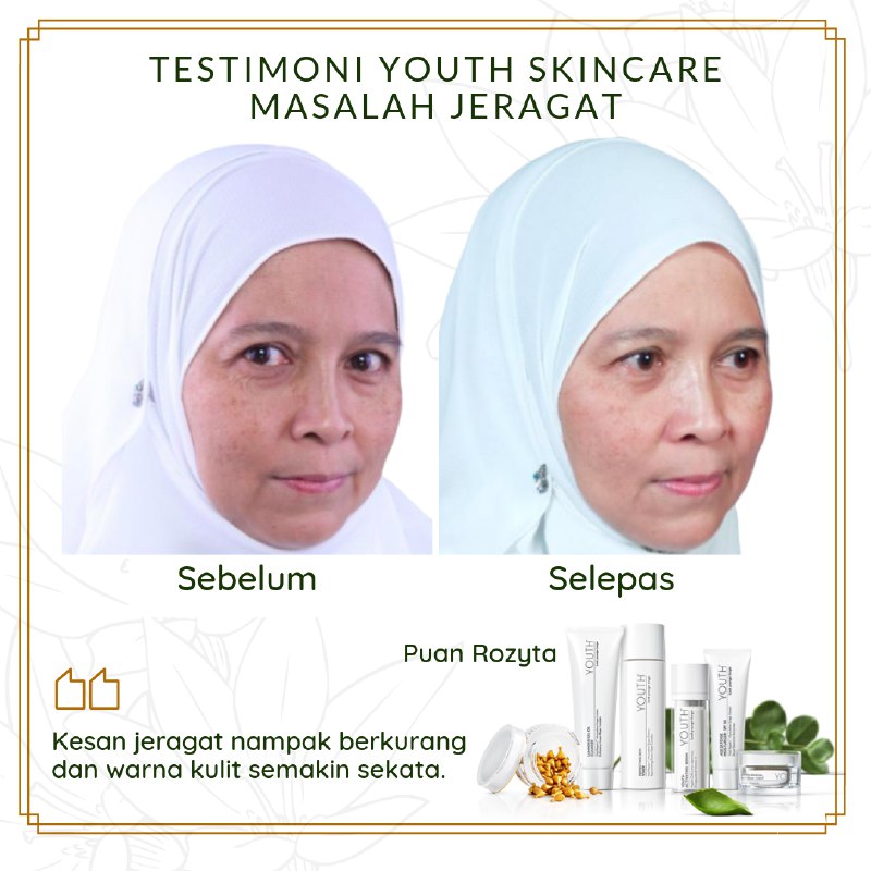 set jeragat shaklee pengalaman guna youth shaklee testimoni serum youth shaklee harga serum youth shaklee benzoil peroksida jeragat testimoni serum shaklee cara hilangkan jeragat, cara hilangkan jerawat dengan cepat, radiance C+E, Uncategorized, Youth Skincare APA ITU JERAGAT ATAU PIGMENTASI? 3 Jenis Hyperpigmenation Apa yang menyebabkan hyperpigmetation jadi makin teruk?  Ramai yang tahu Shaklee dah keluarkan produk skincare mereka sendiri selepas 8 tahun kajian. Alhamdulillah. Dan ju sendiri merupakan antara pengguna setia Youth . Memang banyak sangat perubahan positif bila guna Youth ni tau, yang jerawat dah hilang jerawat, yang kulit kusam dah jadi berseri dan yang jeragat dah jadi makin licin dan hilang jeragat. wah , hebat kan?  Untuk hilangkan jeragat , bahan yang kena uolls kena cari ialah bahan yang mencerahkan kulit atau Brightening Agent dan sebelum tu kena tahu dulu apa punca jeragat ni.  APA ITU JERAGAT ATAU PIGMENTASI? Jeragat atau pigmentation adalah kesan akibat penghasilan melanin yang berlebihan. Melanin ni benda baik sebenarnya, fungsinya macam benteng yang halang sinar UV dari serang sel kulit. Korang tahu kan, sinar UV ni boleh musnahkan kolagen dan elastin, dan galakkan radikal bebas yang boleh rosakkan sel.  Biasanya akan muncul tompok-tompok hitam dan gelap.  3 Jenis Hyperpigmenation Melasma – jeragat yang disebabkan oleh perubahan hormon dan biasanya naik sewaktu mengandung. Biasanya kat muka dan badan. Sunspots – jeragat disebabkan terdedah kepada matahari pada waktu yang sangat lama. Juga dipanggil liver spots atau solar lentigines. Biasanya pada muka dan tangan. Post-Inflammatory Hyperpigmentation – adalah kesan akibat kecederaan pada kulit. contohnya parut hitam kesan peninggalan jerawat. Apa yang menyebabkan hyperpigmetation jadi makin teruk? Sun exposure akan tingkatkan penghasilan melanin. Makin banyak melanin, makin banyaklah pigmentasi/jeragat/tompok hitam pada kulit.  Apa yang menyebabkan hyperpigmentation/jeragat/tompok hitam?