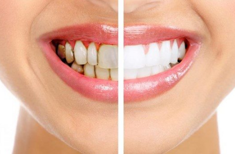 Top 10 Best Natural Teeth Whitening Products