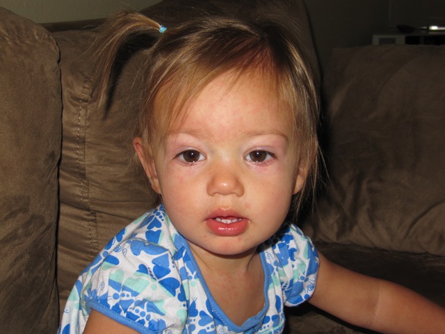 teething rash on face pictures. a rash all over her face,