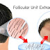  What Are the Steps of FUE Hair Transplantation?