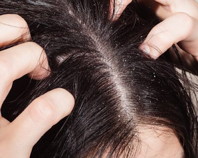 Como acabar com escamação do couro cabeludo após alisamento 