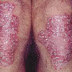 kulit gatal kering mengelupas pada bagian lutut kaki Karena Penyakit Eksim