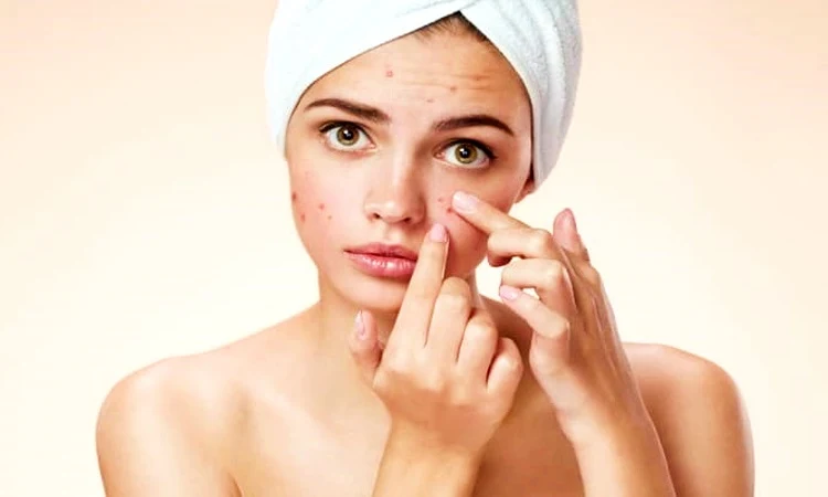 What are the Causes of Acne and How to Prevent Acne?