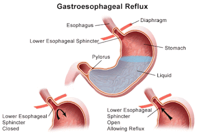 Tips to reduce gastric reflux