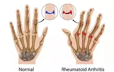 Rheumatoid Arthritis