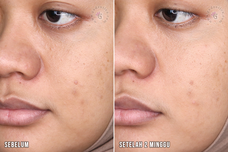 Before After Evershine Bakuchiol Serum