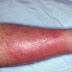 CELLULITIS : DEFINITION , CLINICAL FEATURES ,TREATMENT  &  COMPLICATIONS