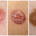 Types of skin cancer - Symptoms of skin cancer -Treatment for skin cancer.