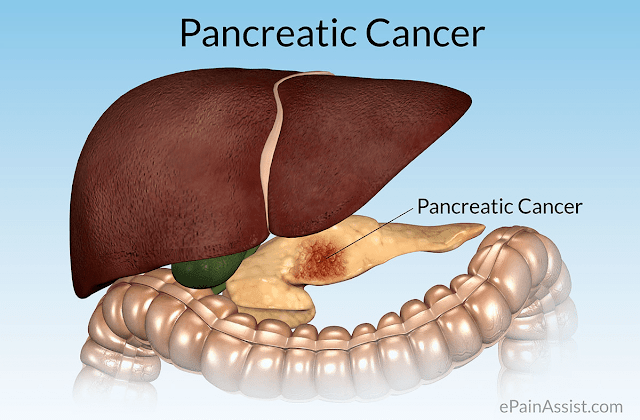 pancreatic-cancer-causes-and-risk-factors