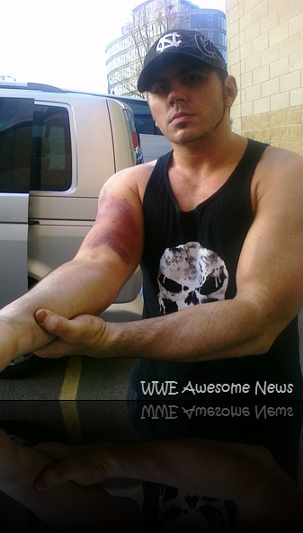 matt hardy lesionado