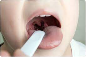 Symptoms, Pictures, Causes, Prevention and Treatment of Tonsillitis