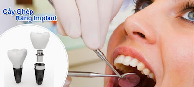 Cấy ghép răng implant có đau không? Phương pháp giảm đau 2