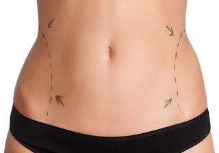 Liposuction in Hyderabad