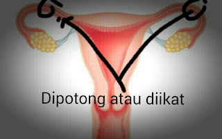 Ada kekhawatiran suami ketika istrinya dianjurkan sterilisasi dari kehamilan Makna Tindakan Steril Kehamilan