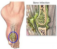 Cara Mengobati Osteomyelitis