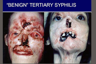  syphilis signs & symptoms