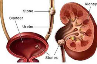 Atasi Batu Ginjal Dengan Herbal