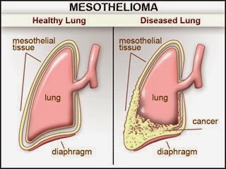 Average Mesothelioma Settlement Amounts - Average Mesothelioma ...