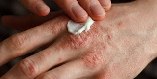 Penyakit gatal eksim Dermatitis, Contoh Gambar Penyakit Kulit Eksim, Obat Salep Buat Eksim Kering, Mengobati Eksim Basah Pada Bayi, Gatal Di Selangkangan Disebabkan Oleh, Eksim Menghitam, Mengobati gatal eksim Basah Pada Kaki, Tips Menghilangkan Eksim Secara Alami, Obat Eksim Pada Selangkangan, Gatal Di Area Kelamin Laki Laki, Makanan Mengobati gatal eksim, Eksim Kering Menahun, Mengobati Penyakit gatal eksim Kering, Eksim Obatnya Apa, Cara Pengobatan gatal eksim Pada Bayi, Obat Dokter Penyakit Eksim, Obat Eksim Esperson, Gatal Didalam Kemaluan Pria, Gatal Di Pangkal Kemaluan, Penyakit Gatal Di Kemaluan Laki Laki, Penyakit Eksim Di Tangan, gatal eksim Pada Telapak Tangan, Obat Eksim Kering Tahunan, Cara Mengobati Penyakit Kulit Eksim, Gatal Di Selangkangan Berwarna Hitam, Obat gatal eksim Ramuan Cina, Nama Obat Gatal Di Kemaluan Pria, Madu Mengobati Eksim 