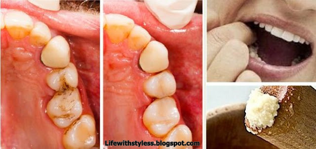 Heal Tooth Cavities Yourself and Relieve Pain Quickly at Home