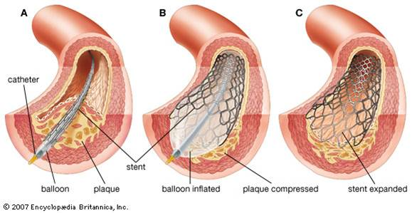 coronary stent
