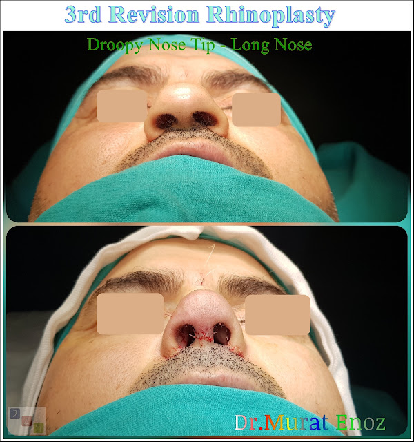 3rd Revision Rhinoplasty - Droopy Nose Tip - Tertiary Nose Job For Men