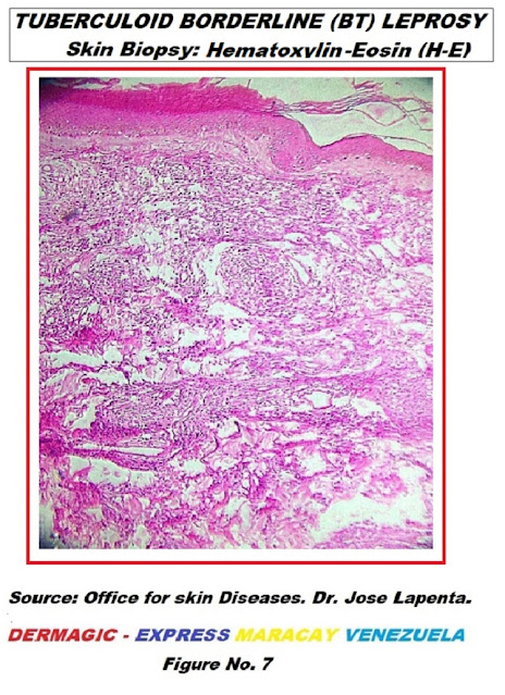 Borderline tuberculoid leprosy, Hematoxylin Eosin stain.