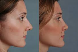 suitable candidate for rhinoplasty,rhinoplastry before and after,rhinoplasty surgery