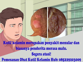 Obat Kutil Kelamin