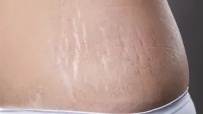 علامات التمدد