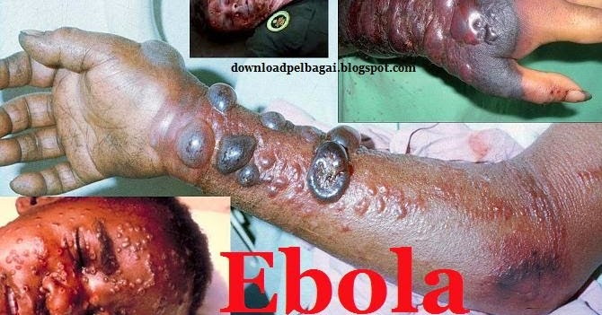 10 Tips Cegah Dijangkiti Ebola  Download Percuma