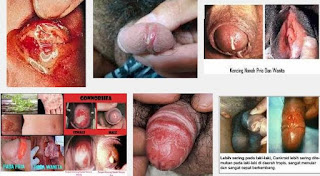 Obat Kencing Terasa Perih Dan Bernanah