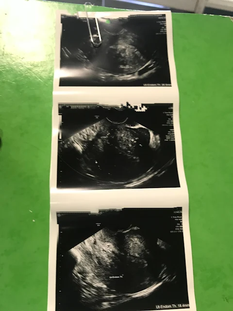 Ultrasound images showing only a small amount of remaining tissue after a miscarriage