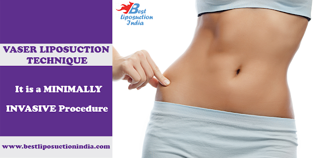 liposuction in delhi