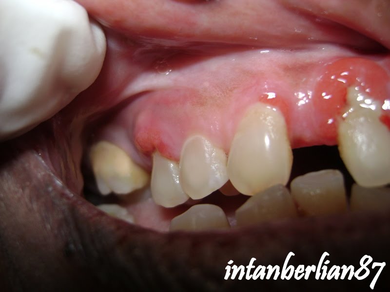 Multiple periodontal abscess in diabetic patient berserta 