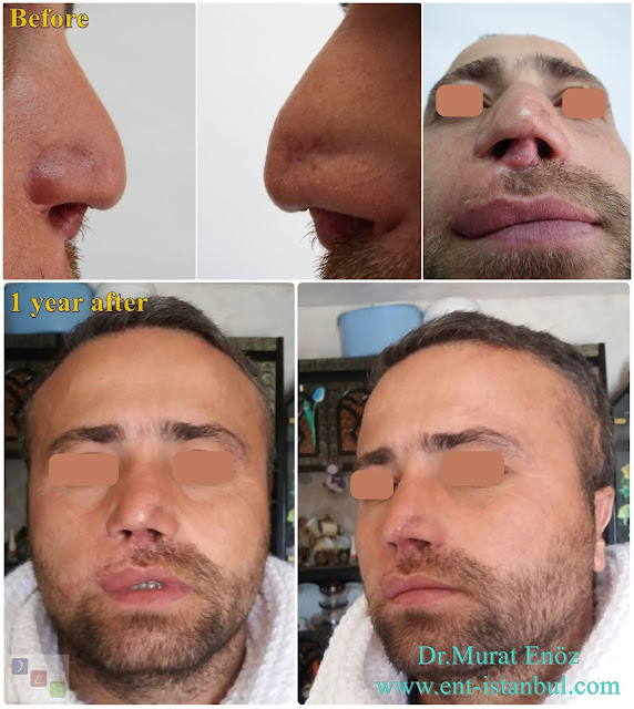 Complicated Revision Rhinoplasty, Revision Nose Job For Male, 8th Nose Operation