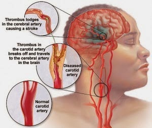 Serba-Serbi Stroke