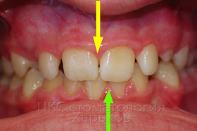 Несоответствие средней линии верхнего и нижнего зубного ряда