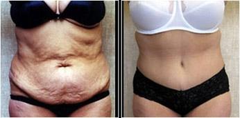 Tummy Tuck (Abdominoplasty)