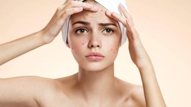 Terapi jerawat: Perawatan klinis dapat membantu membersihkan kulit