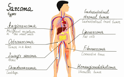 What is sarcoma cancer    ما هو مرض ساركوما