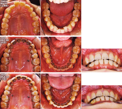歯列矯正：定期検診その10